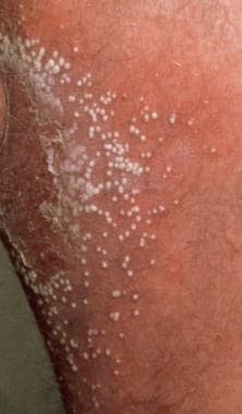 infantile psoriasis differential diagnosis