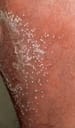 Pustular Psoriasis