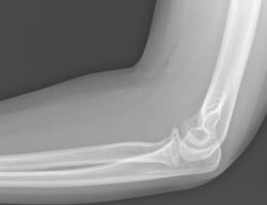 coronoid process radiograph