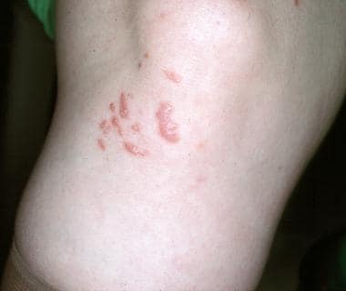 Erythematous papules on the knee. 