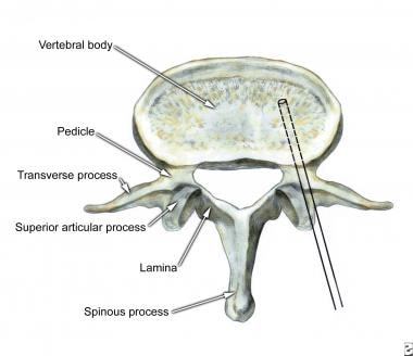 Percutaneous vertebroplasty, transpedicular approa