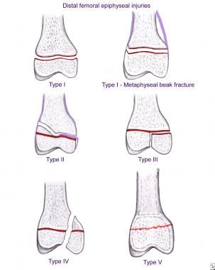 Depiction of various Salter-Harris types of distal