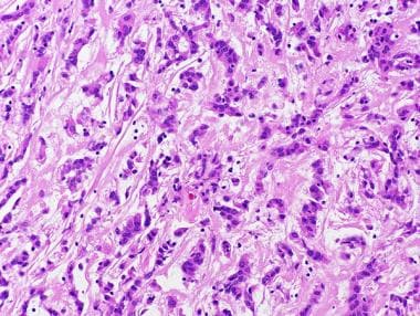 Chordoid glioma is characterized by cords of epith