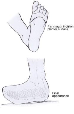 Top image shows fish-mouth incision on plantar sur