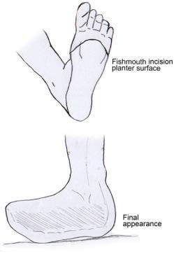 Living with a partial foot amputation