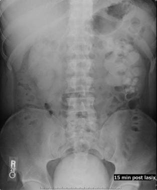 Excretory urography with Lasix: A 15-minute radiog