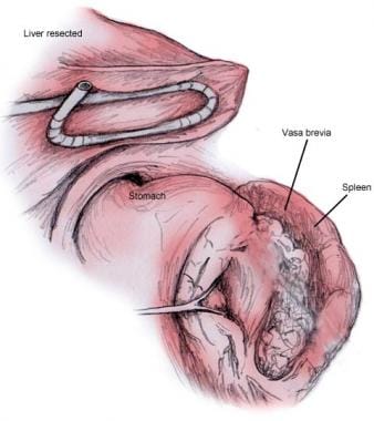 Laparoscopic Nissen Fundoplication Technique: Laparoscopic Nissen  Fundoplication, Complications