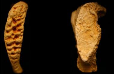 Pubic symphysis faces depicting young billowy bone