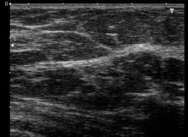 Normal breast ultrasound. The woman is older than 