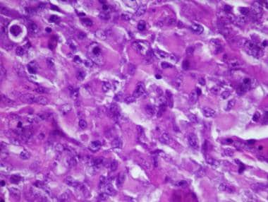 Pathology of Embryonal Tumors. A histologic sectio