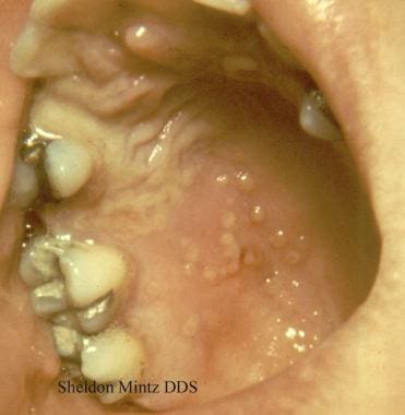 复发性疱疹偶见于口内