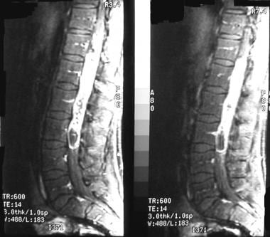 cauda equina vs conus medullaris syndrome