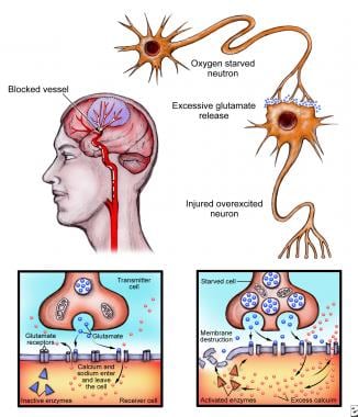 When the brain suffers an injury, such as a stroke