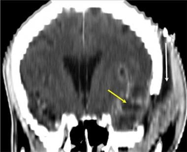 Brain abscess. Coronal multiplanar reformatted CT 