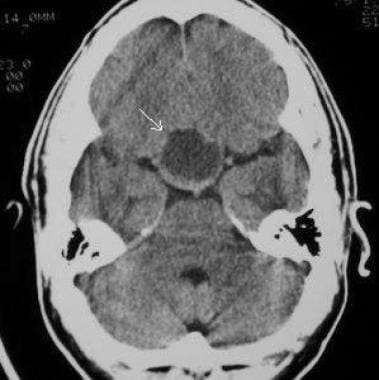 Axial CT scan in a 39-year-old man (same patient a