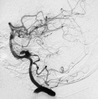 An angiogram showing a bilobed aneurysm of a poste