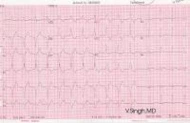 infarto anterior ecg anormal