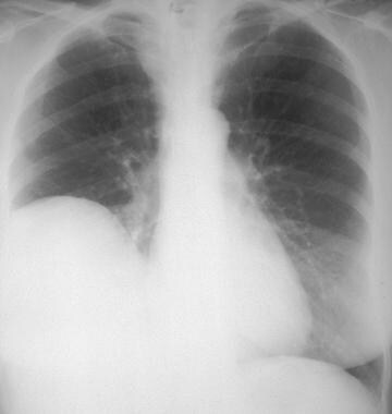 Posteroanterior chest radiograph shows a large mas