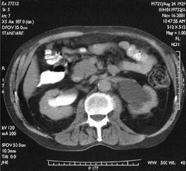 Transaxial enhanced abdominal CT scan in a 72-year