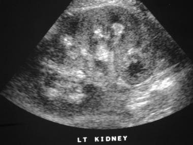 Renal longitudinal sonogram in a patient with neph