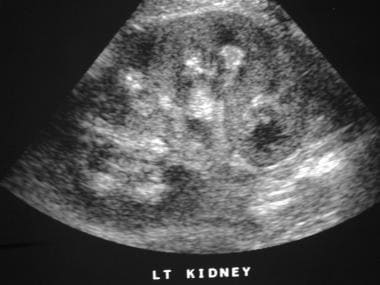 what do kidney stones look like on ultrasound