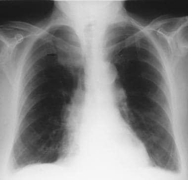 Anteroposterior chest radiograph of an 86-year-old