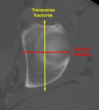 transverse fractures