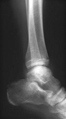 Plain radiograph of the left ankle in an adult pat