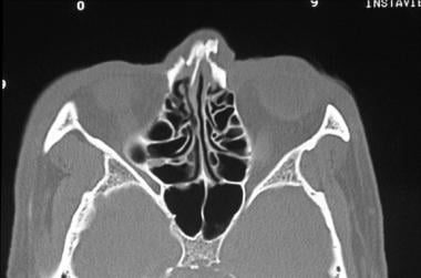 Nasal fractures. Axial CT scan demonstrates a nasa