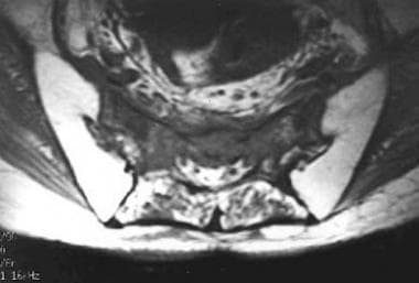 Axial T1-weighted MRI of the sacrum demonstrates d