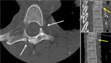 Thoracic spine trauma. Axial CT image of an unstab