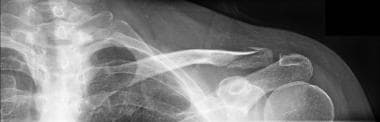 Type 2 clavicular fracture (lateral third). 
