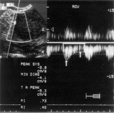Duplex ultrasound scan of an endometrioma. Note th