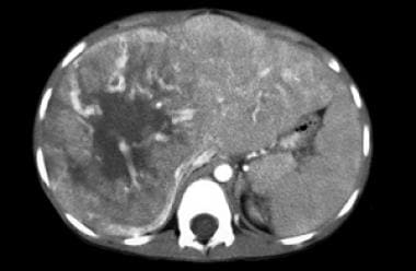 Contrast-enhanced CT of a 7-year-old boy with hepa