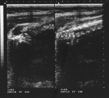 Antenatal ultrasonogram shows a lumbar meningocele