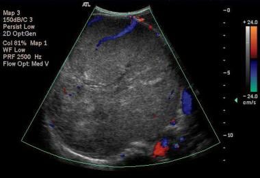 Color Doppler US scan of the right kidney in an ax