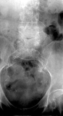 Radiograph shows calcification of the abdominal ao