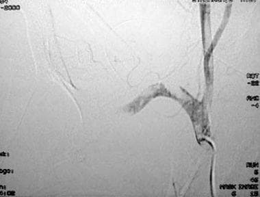 An angiogram obtained in a 45-year-old woman with 