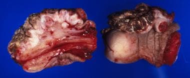 Squamous cell carcinoma of the penis: This lesion 