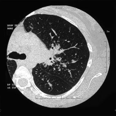 Stage II sarcoidosis. Courtesy of Anthony Notino, 