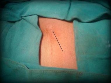 Open inguinal hernia repair. Draping and incision.
