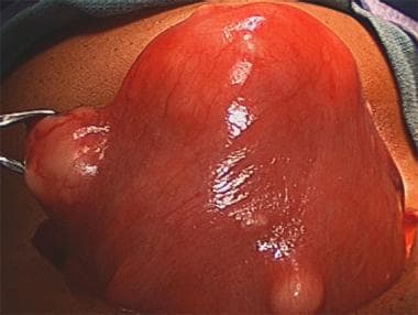 Fibroid uterus. (Photo courtesy of M Behera, MD.)