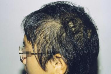 Diffuse alopecia areata. 