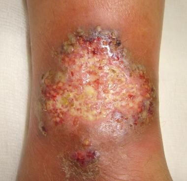 Close-up view of pyoderma gangrenosum in a patient