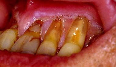 Severe dental abrasion and gingival recession due 