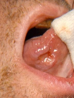 Ulcer on the ventrolateral surface of the tongue. 