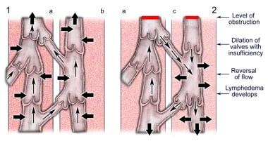 Lymphedema: Practice Essentials, Background, Pathophysiology