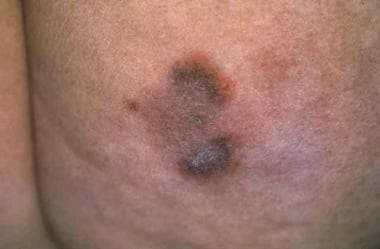 This example of lymphocytoma cutis shows a localiz