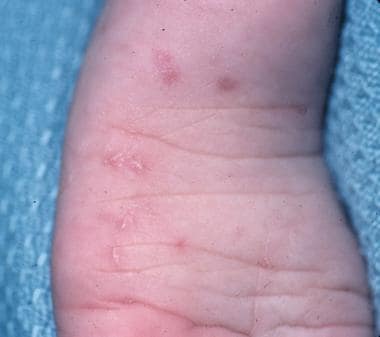 Scabies Linear Burrows