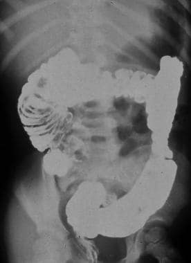 Intestinal obstruction in the newborn. Radiograph 